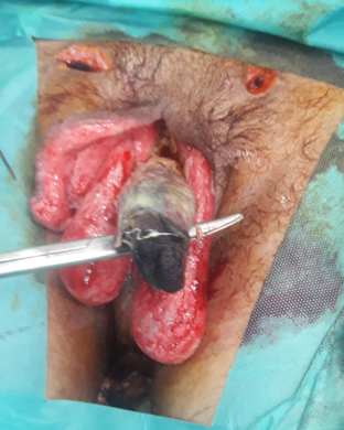 Figure 1: Ischemic gangrene of the penis.