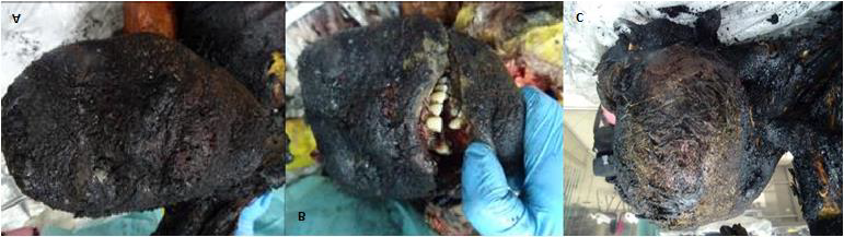 Figure 11: Photographic Findings of the Judicial Autopsy on F’s Body. A: Carbonized Facial Soft Tissues with Bone Exposure. B: After the Incision of Perioral Tissues, a Dental Formula was Performed and an Orthodontic Metal Bridge was Found on Element 21. C: Residual Hair was Found in the Occipital-Nuchal Region.
