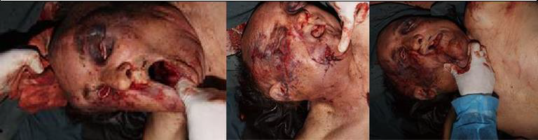 Figure 3: Photographic Evidence of the Cadaveric Inspection on Body C. The Face was Completely Destractured, With Disarrangement of the Bony Structures of the Facial Massif. Contused-Lacerated Wounds on the Frontal-Paretial Region and Chin Region were Visible, with Sunken Eyeballs. The Entire Right Side of the Face Showed Ecchymotic Mass from the Right Mandibular Angle to the Right Supraorbital Region. The Entire Left Side of the Face Presented an Extensive Excoriated Ecchymotic Complex.