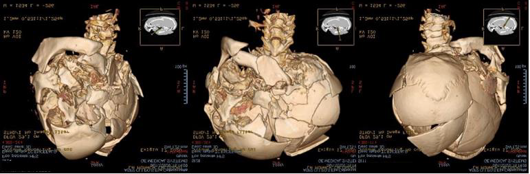 Figure 6: Cranium and Brain CT Scan with 3D Reconstruction. This Technique Revealed the Multiple Fractures of the Skull and Facial Massif; Those Complex Fractures had Decomposed and Overlapping Edges, Resulting from the Application of a Crushing Force on the Left Anterolateral Side of the Face. There are Subarachnoid Blood Collections, Soft Tissues Subcutaneous Emphysema of the Facial Massif and Left Temporo-Occipital Epidural Pneumocephalus.