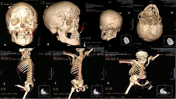 Figure 7: Skull-Brain and Chest-Abdomen-Pelvis CT Scan with 3D and MPR Reconstruction.