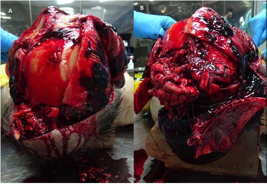 Figure 9: Photographic Findings of the Judicial Autopsy on C Body. A: On the Head Section, Diffuse Blood Infiltration from the Internal Layer of the Scalp and Periosteum with Multiple Cranial Vault Fractures from which the Encephalic Parenchyma Herniated. B: Focusing on the Encephalon, there was Diffuse Subarachnoid Hemorrhage and Scattered Intraparenchymal Bleeding Areas.