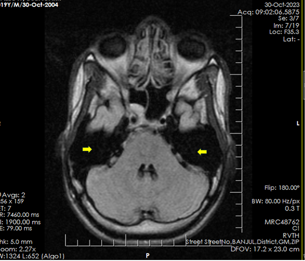 Figure 1: Marked dilatation of mastoid air cells bilaterally (yellow arrows).