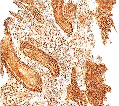 Figure 1: Endometrial tissue sample showing strong estrogen receptor positivity 200x .