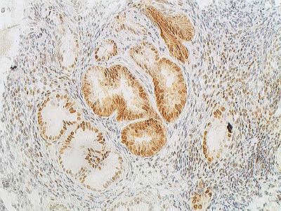 Figure 2: Endometrial tissue sample showing strong progestogen receptor positivity 200x .