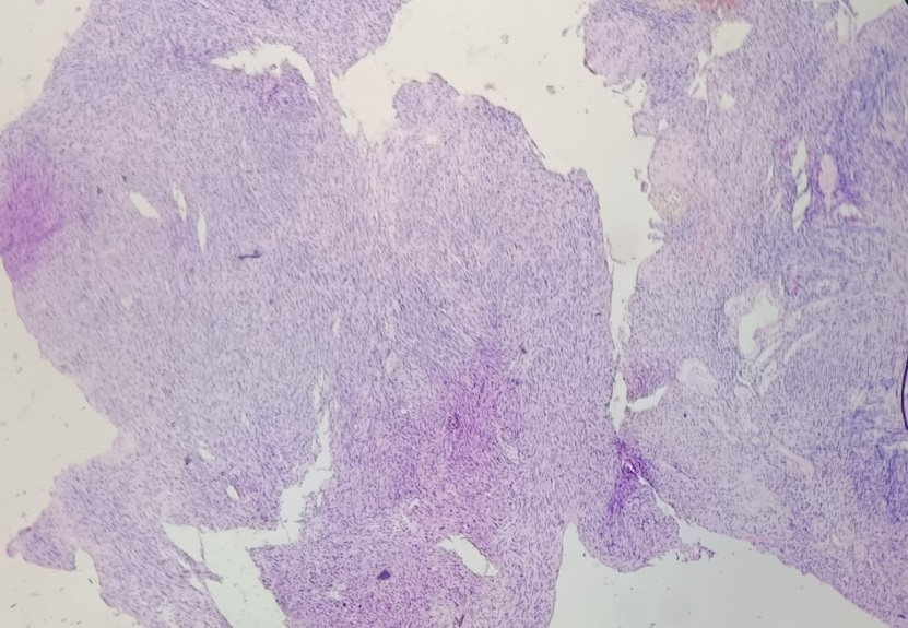 Figure 3: Histopathogical examination show a tumor composed of highly cellular, compact areas of Antoni A tissue and devoid of Verocay bodies. A loose microcystic areas noted (Haematoxylin & Eosin stain 40x).