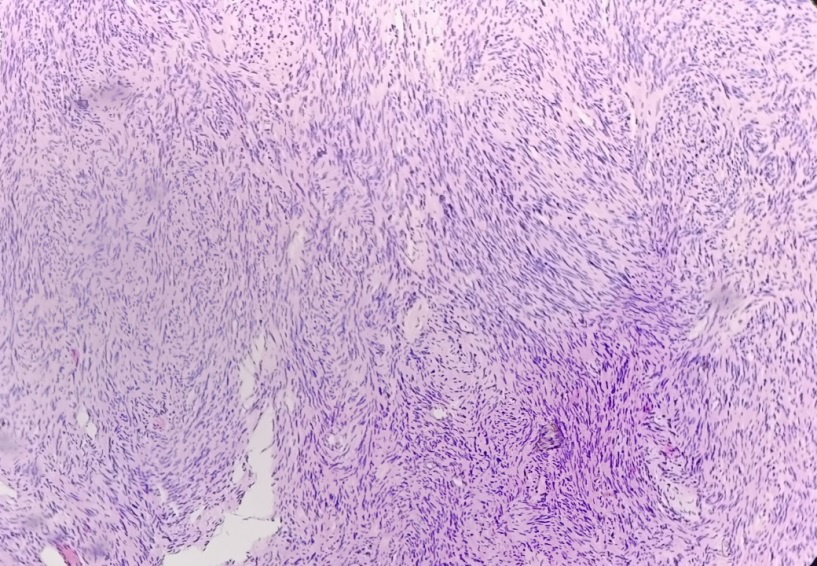 Figure 4: Tumor composed of highly cellular, compact areas of Antoni A tissue (Haematoxylin & Eosin stain, 100x).