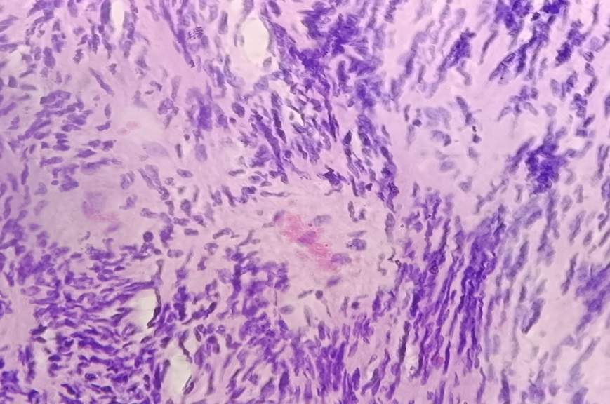 Figure 5: Tumor composed of highly cellular, compact areas with variable hyperchromasia and pleomorphism (Haematoxylin &Eosin stain, 400x).