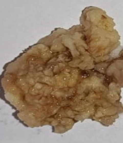 Figure 7: On gross irregular, grey-white, soft tissue lesion.