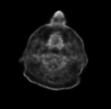 Figure 1: ** Gross image showing vascularized violaceous growth on physical examination.