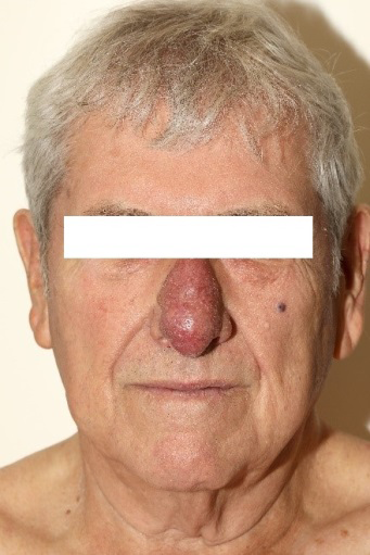 Figure 2: A PET scan revealing hypermetabolic ill-defined cutaneous and subcutaneous thickening of the nose.