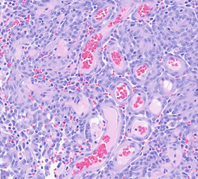 Figure 5: Gross image post subtotal-rhinectomy.