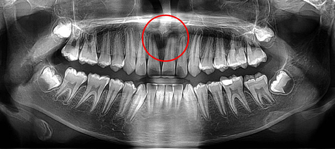 Figure 2: Panoramic radiograph showing incisive canal cyst or nasopalatine duct cyst between permanent maxillary two central incisors (Red circle).