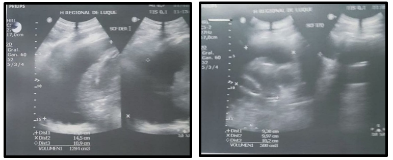 Figure 1: Abdominal ultrasound images, right and left sides, respectively.