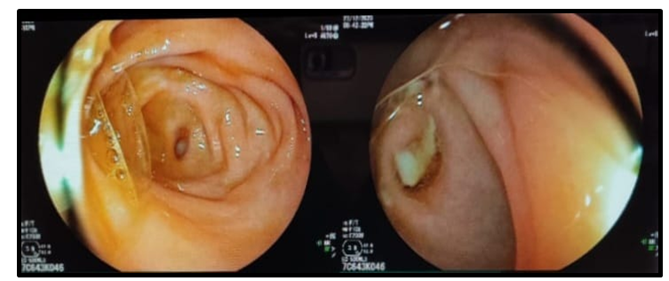 Figure 3: Colonoscopy image showing purulent discharge from an orifice suspected to be the appendiceal opening at the level of the cecum.