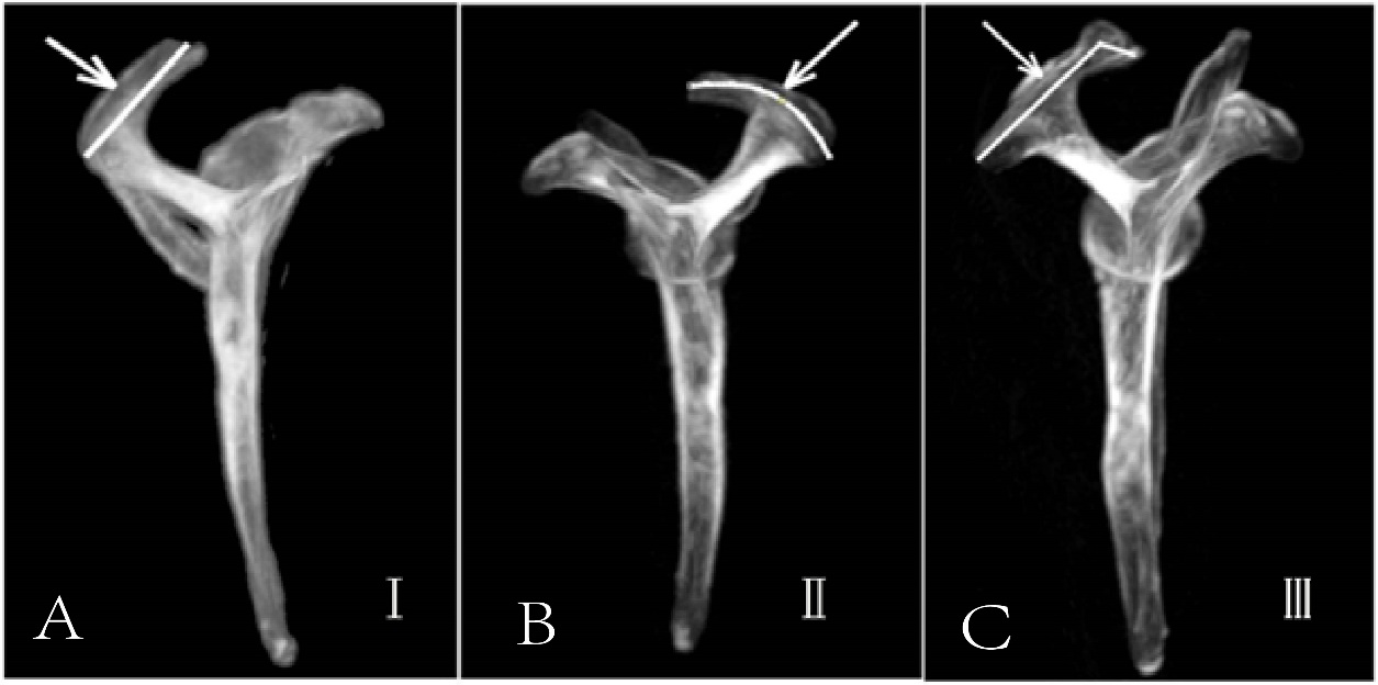 Figure 1: Acromion Classification (A-C). The MIP Reconstructed Images After The CT Scan: A: Type Ⅰ Acromial Flat Type; B: Type II Acromial Arc; C: Type III Acromial Hook