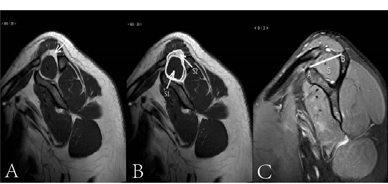 Figure 5: A: Oblique Sagittal T1WI Image, White Signal Represents Adipose Tissue (Arrow) (Fuchs Grade); B: Oblique Sagittal T1WI Image, S1 for Supraspinatus Muscle, S2 for Fat +S1, S1/S2=OG, (Thomazeau Classification); C: Oblique Sagittal Fat Suppression T2WI Image, Line Segment AB is the Connection Between the Superior Edge of the Two Ends of the Scapula, S Represents the Supraspinatus Muscle, S Above AB Is I°, Near AB is Ⅱ°, Slightly Below AB Is Ⅲ°, and A Little Residual S Is Ⅳ° (Warner Classification).