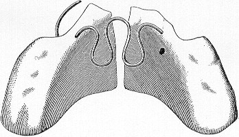 Figure 12: Cutter HE dental models before, after and during treatment.