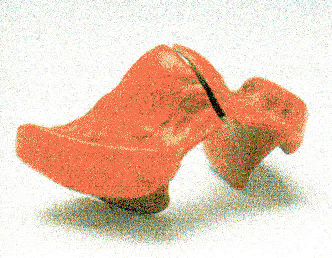 Figure 16: Robin P Glossoptosis.