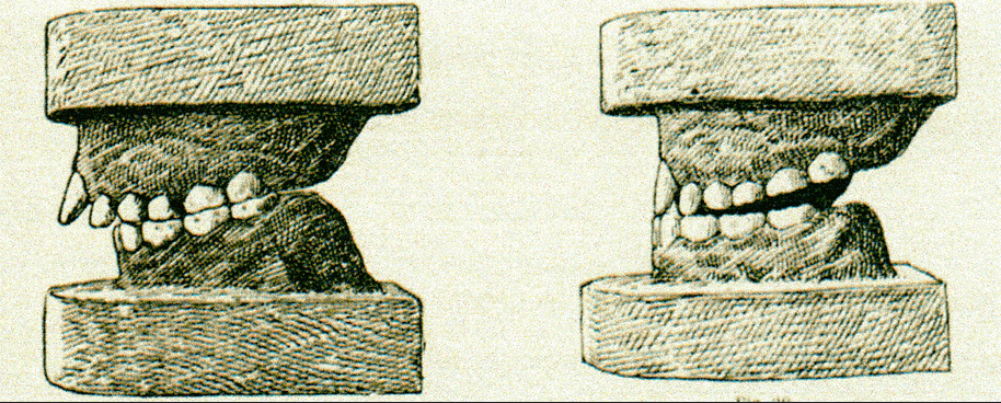 Figure 17: Robin P upper midline expansion appliance.