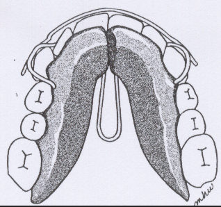 Figure 18: Robin P Monoblock functional appliance.