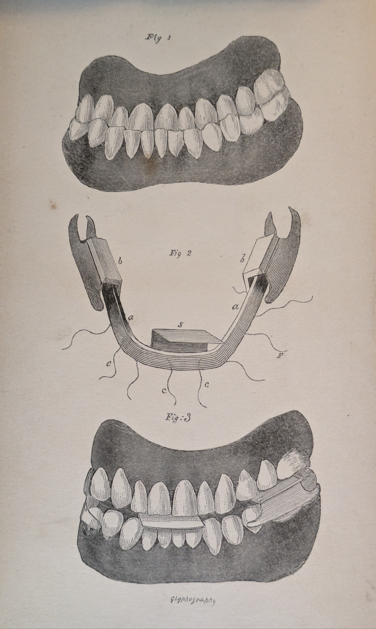 Figure 3: Robertson W Inclined Plane Appliance.
