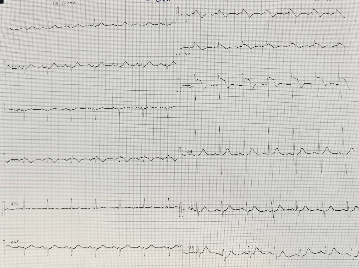 Figure 1: ECG on Admission.