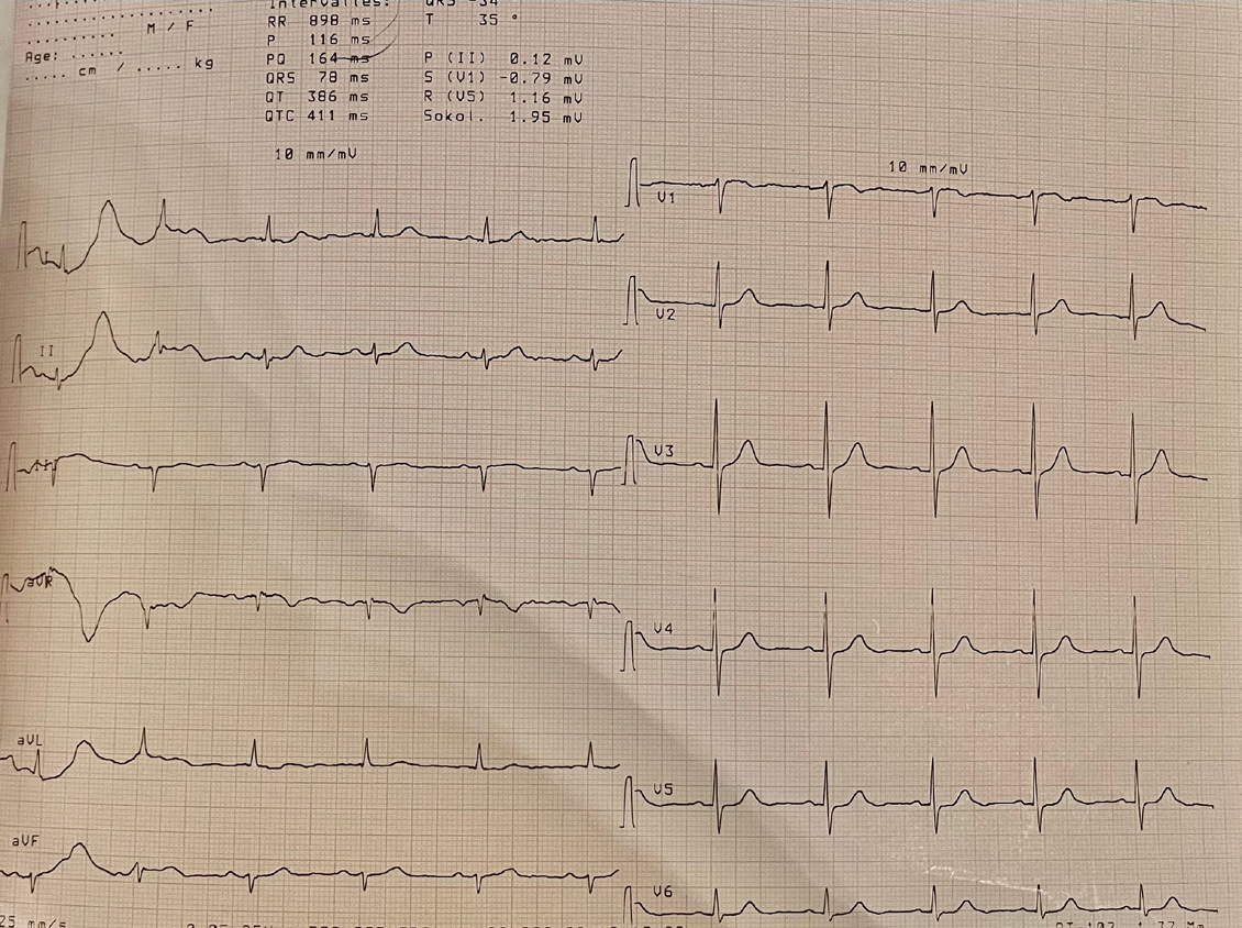 Figure 3: ECG After Apyrexia.
