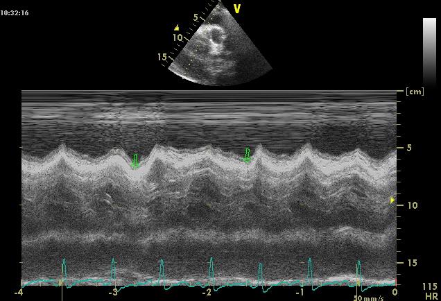 Figure 2: echocardiographic image in TM mode showing a pericardial effusion of great abundance with a meso-dia diastolic compression of the right ventricle (arrows) in one of our patients. The biological inflammatory syndrome has only an orientation value. The bacteriological examination of pericardial fluid is most often negative in our regions (85%) and the search for non-contributing acid-fast bacilli. The ECG is sometimes useful for diagnosis especially in our regions where the technical capacity is limited. It attracts our attention to peripheral and / or diffuse micro voltage, a non-specific sign, but of high orientation value. All our patients had this sign. In addition, the ECG may indicate signs of poor tolerance including electrical alternation which was noted in 15.0% of our patients. Echocardiography is an essential examination in the diagnosis and etiologic orientation of tamponade. Indeed, the positive diagnosis of tamponade by TTE is easy. However, its etiology remains an enigma in our regions and the TTE is a great contribution in this approach by appreciating, besides the abundance, the appearance of the liquid, the presence or not of fibrin. Tuberculosis is the most common etiology in our country. It is characterized by an abundance of pericardial effusion, often circumferential, which can rapidly involve the vital prognosis by a tamponade, the presence of fibrin network, a sero-hematic fluid predominantly lymphocytic [8,9]. In our study, echocardiography noted the presence of a fibrin network in 55.0% of individuals and the puncture fluid was sero-hematic in the same proportions. In addition to diagnosis, the TTE allows the indication and control of pericardiocentesis, the only life saving procedure in this type of emergency (class I recommendation) [2] (Figure 3). Removal of fluid, even in small quantities (30 - 50 ml), makes it possible to stop the compression and relieve the patient.