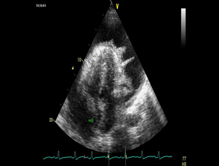 Figure 3: Echo cardio graphic image in 2D showing a pericardial effusion of great abundance with compression of the right atrium (arrow) and the presence of fibrin network in one of our patients. The prognosis of this complication is intimately linked to its cause and therefore to its proper management by a specific treatment. Thus, patients received anti- tuberculosis drugs in 37.5%, antibiotics in 25.0%. To avoid evolution towards constriction in bacterial infections specific or not, corticosteroid therapy is necessary in association with the specific treatment. The use of corticosteroids is controversial. However, studies in the literature [10,11,12] suggest that their association with specific therapy is associated with decreased mortality, decreased frequency of pericardiocentesis or pericardiotomy. Non steroidal anti-inflammatory drugs were administered to 77.5% of patients according to guidelines [13] (Figure 4).