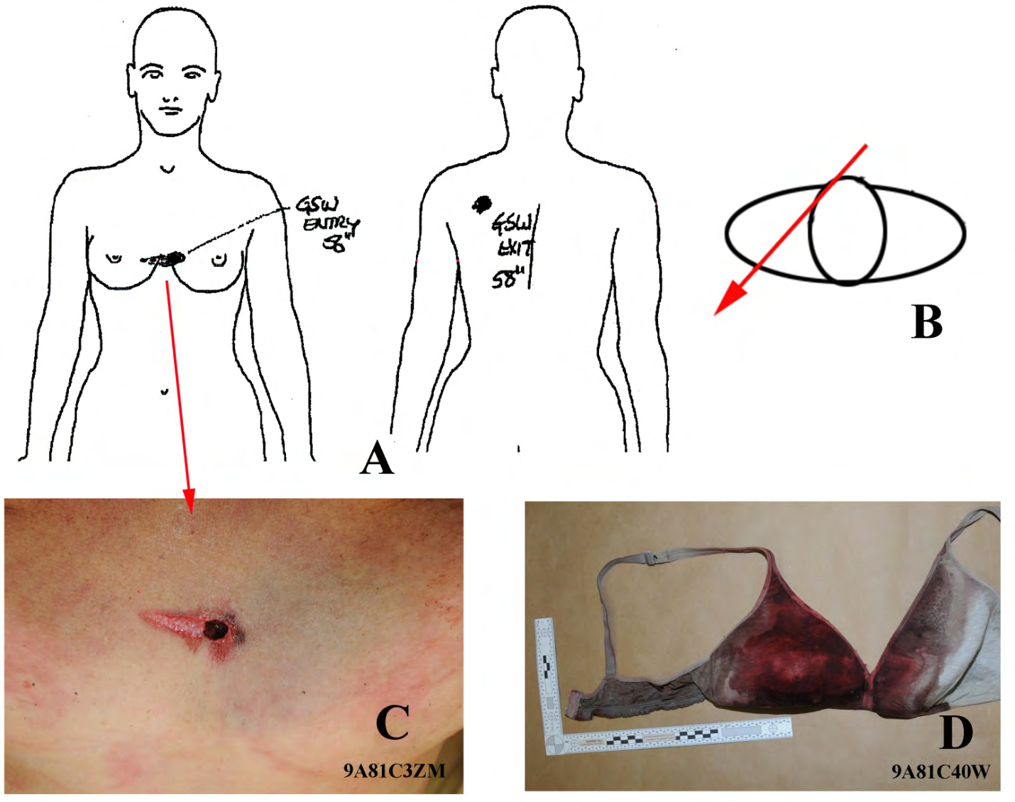 Figure 10: Angela Leird’s bullet wounds and trajectory. A. Drawings from the Angela Leird autopsy report [4]; left, anterior view of the body showing the location of the entrance wound in her chest. Right is the drawing of the posterior body. The bullet exit wound is at her upper left back. According to the autopsy report, the bullet deflected upward off Leird’s sternum. B. Estimated bullet trajectory (from A) on the horizontal plane through Leird’s body; she was rotating counterclockwise when shot. C. Image after the body was cleaned shows the bullet entry wound with an abrasion, which likely originated from the bullet’s contact with the strap between the bra cups. D. Leird’s bra; the strap between cups likely produced the abrasion associated with the bullet hole seen in C. Curiously, no damage to the strap was noted where the bullet contact likely occurred.