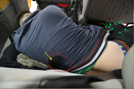 Figure 8: Back of the Corpse with a Saturation Stain on the Fabric at the Level of the Exit Wound and a Lot of Smaller and Larger Spatter Stains on the Fabric of the Trouser Part that Corresponds to the Fronts of Both Pants.
