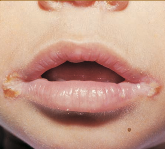 Figure 2: Riboflavin deficiency marked by angular stomatitis with maceration.
