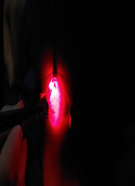 Figure 4: On table transillumination test for neck cyst.