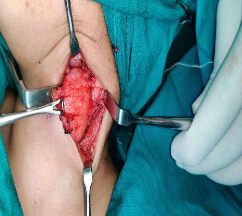 Figure 5: An intraoperative image demonstrating the primary neck vessel’s integrity following careful dissection from the surrounding environment.