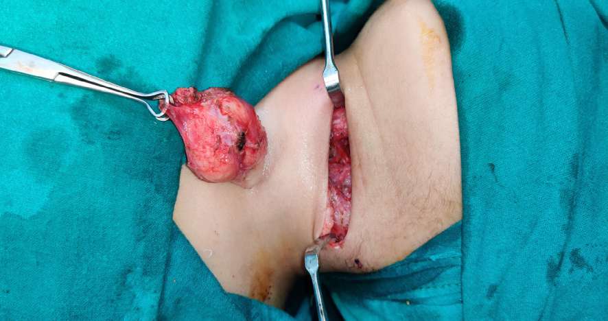 Figure 6: Intraoperative picture, following successful removal of the neck cyst.
