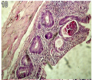 Figure 10: Section in the caecum from group (1) chicks showing acute and chronic inflammatory cells collected at the depth of the mucosal crypts forming a small crypt abscess (H&E X250).