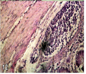 Figure 12: Section in the caecum from group (2) chicks showing inflammation of all layers of intestinal wall with parasitic granuloma composed of chronic inflammatory cells and fibrosis (H&E X 350).