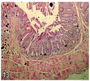 Figure 13: Section in the caecum from group (3) chicks showing partial shedding of the mucosa, ulceration and infiltration by a large number of acute and chronic inflammatory cells (H&E X250).