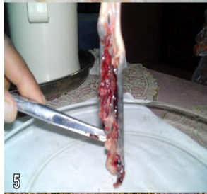 Figure 5: Caeca opened to show haemorrhagic debris. There may be firm caecal cores in subacute cases or that recovering in control chicks.