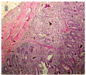 Figure 9: Section in the caecum from group (1) chicks showing transmural inflammation affecting all layers of the intestinal wall with submucosal invasion by schizonts (H&E X200).