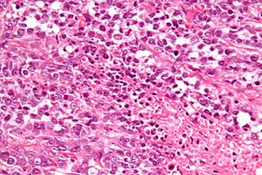 Figure 1: Small cell carcinoma of ovary depicting diffusely disseminated small cells with scanty cytoplasm and centric, uniform nuclei. Surrounding stroma is fibrotic.