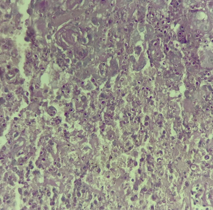 Figure 2: H&E-stained section showing granulomatous inflammation with intracellular yeasts (magnification ×200).