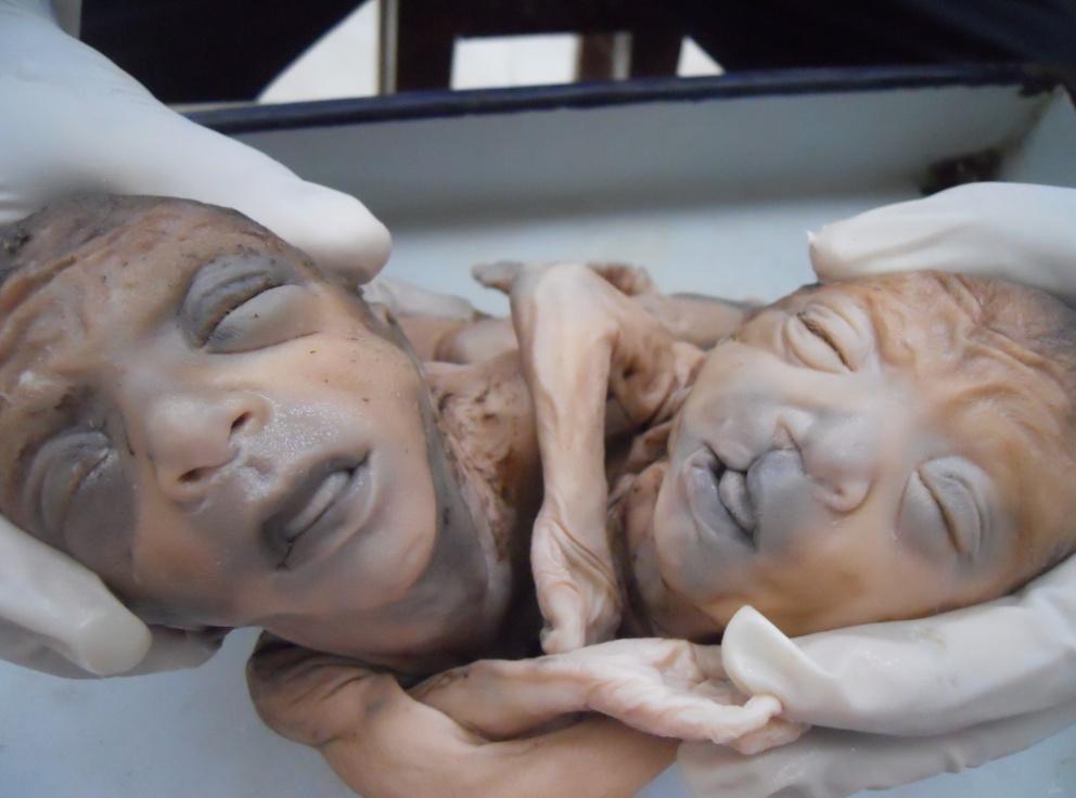 Figure 1: Image of a Thoracopagus twins after vaginal delivery at 34 weeks of Gestation.