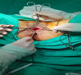 Figure 1: Vaginal and bladder dissection and presence of muscle fascia.