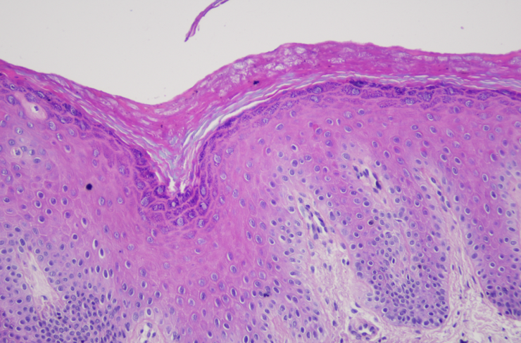 Figure 2: The biopsy showed hyperkeratosis, hypergranulosis and perivascular mild lymphocytic infiltrate in the superficial dermis.