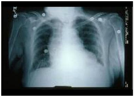 Figure 7: X- ray of the heart.