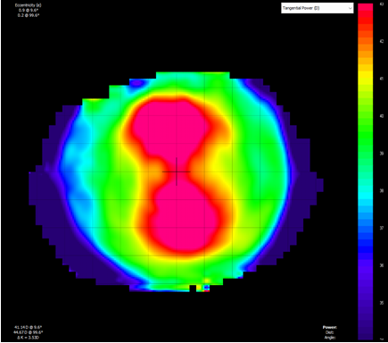 Figure 2: Corneal topography pattern of a symmetrical bow-tie cornea. It is important to understand that corneal topographer indices are not interchangeable with different manufacturers and different models. In a young Chinese population, Pauline Cho evaluated the performance of four topographers (Humphrey Atlas 991, Orbscan II, Dicon CT200, Medmont E300) and concluded that apical radius and eccentricity cannot be used interchangeably between machines in the calculation of orthokeratology lenses [21]. When comparing the apical radius, eccentricity, and elevation measures, the Orbscan II performed the poorest. Meaning the experiment compared apical radius, eccentricity and elevation where applicable between the machines, the Medmont E300 and the Humphrey Atlas 991 provided the most repeatable and reproducible measures of apical radius and eccentricity. For better first fit success the authors suggest that practitioners take repeated scans so that the practitioner has a more accurate representation and understanding of the cornea prior to treatment. They also found that the number of repeated readings that should be taken for a precision of 2 µm (elevation) were 12 measurements for the Humphrey but only 2 measurements for the Medmont.
