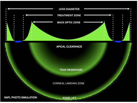Figure 4: A schematic of the different curves of myopic orthokeratology lenses. This features a central back optic zone fitted flatter than flat K. There is then a steeper zone known as the reverse curve (tear reservoir), followed peripherally by a flatter curve for corneal alignment (corneal landing zone). The final most peripheral curve is the edge lift.