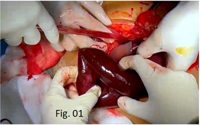 Figure 1: Intraoperative Finding of Gangrenous Jejunal Loop with Inflammatory Fluid Upon Emergency Open Laparotomy.
